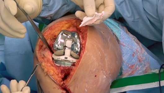 Best knee replacement surgeon in Noida