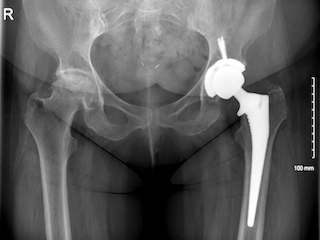 Best hip replacement surgeon in Noida