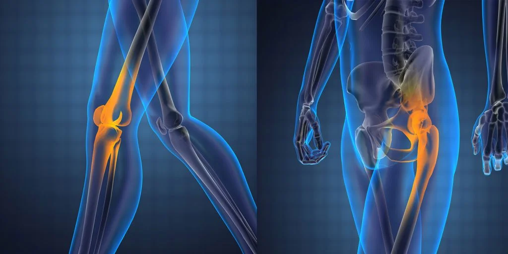 When Do You Really Need a Knee or Hip Replacement?
