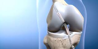 ACL Injuries and Arthroscopy in Sports