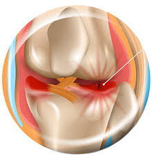Mensical Repair Surgery